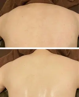 肌荒れの無い美背中に🪞酵素ハーブピーリングで徹底毛穴ケア🤍ツヤのあるきめ細かいお背中に💫