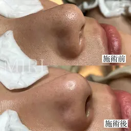 黒ずみ毛穴撃退！✨毛穴プレミアムコース100分【デコルテマッサージ付き】初回カウンセリング込120分