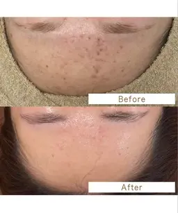 ハーブピーリング＋ピュアビタミンC美容液