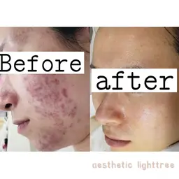 人気No.2🤎ニキビ、ニキビ跡、毛穴、乾燥肌卒業フェイシャルエステ🫧