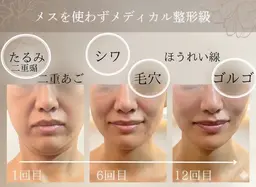 【初めての方/5名限定】韓国最新Vリフト小顔マシン+7Dコルギ/95分¥16999→8,999円