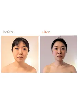 たるみ、むくみ、くまをスッキリ改善！リフトアップ小顔✨