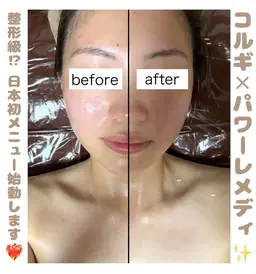 【日本初導入❤️‍🔥】コルギ×パワーレメディで3D小顔矯正💆🏻‍♀️✨速攻で整形級の変化に🥹