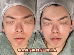 【メンズもOK、プレミア毛穴レス/陶肌ケア】★毛穴洗浄×光フェイシャル