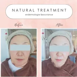 minimo sale2/29まで【最新マシンですっきり小顔】❤ヒアルロン酸増量うるツヤ美肌✨エンダモロジー フェイス✨