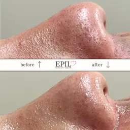 ハイドロスプラッシュ毛穴洗浄＋フェイス脱毛［Google口コミ投稿価格❣️］