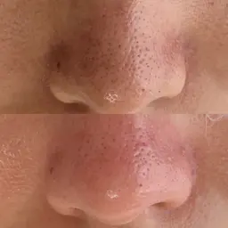 撮影OKの方募集🔥【話題の毛穴洗浄】毛穴エクストラクションプロ