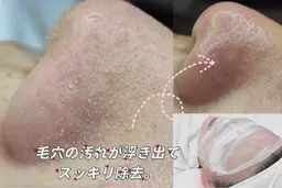 【3月限定】\毛穴黒ずみ＆開き／毛穴洗浄＋保湿パック［小顔首肩リンパ付］50分