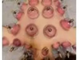 ◆カッピング◆首肩背中スッキリ、血行促進♪体のだるさ・冷え性解消