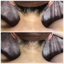 《パーツ脱毛》うなじ