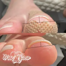 【フット】両親指のみ巻き爪ケア