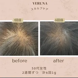 【薄毛】【円形脱毛】【分け目】スカルプトゲケア！毛根に栄養をたっぷり与えて、毛根生き生きと蘇らせる！再生ケア！3回コース