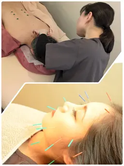 メイクしたままOK✨【カラダの鍼灸＋お顔の鍼＋ヘッドマッサージ　60分】