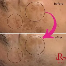 【REVIマシン】光フェイシャルでトラブル肌改善☆鎮静パックプレゼント付🎁