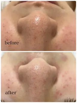 【平日限定】毛穴の黒ずみキレイにしませんか✨毛穴洗浄＋極上フェイスマッサージ＋美肌パック付き