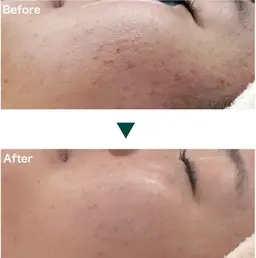 【赤ニキビ・ニキビ跡】ピーリング 50分