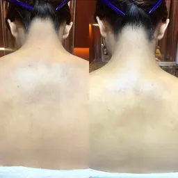 〈 撮影・口コミ投稿 OKな方限定〉レディースシェービング【襟足・背中】