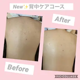 【ご新規様限定】🔸背中ケア美白コース