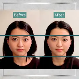 再来1ヶ月以内の方！癒着剥がし美容鍼・小顔矯正・最後顔から肩のマッサージ