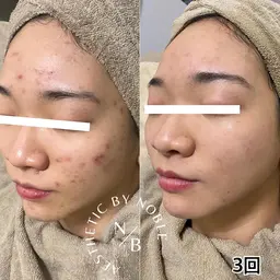 【モニター募集】【当日限定】剥離ありハーブピーリング顔 16,800円→6900円