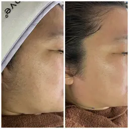 【肌質改善フェイシャルワックス】ニキビや炎症が気になる、できやすい方！！お得すぎるホームパック3日分set🎁