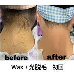 【女性/学割U２４/２４歳以下なら社会人も◎】うなじワックス+光脱毛￥3,980