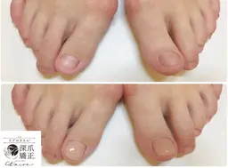 【深爪矯正★男性フット】お試し1回体験