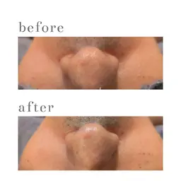 【お試し!本気の肌改善】✨️ハーブピーリング(クリスタルパック)60分*