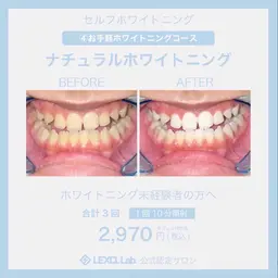 【初回限定】自然な歯本来のピカピカの白さを目指していきます😁〈30分照射コース〉