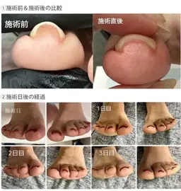 巻爪矯正2本付き！！他店オフ込みフットワンカラー！