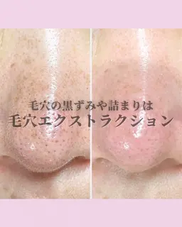 毛穴の汚れ、黒ずみ、ざらつき毛穴解消はこれ！大人気✨毛穴エクストラクション❤︎︎