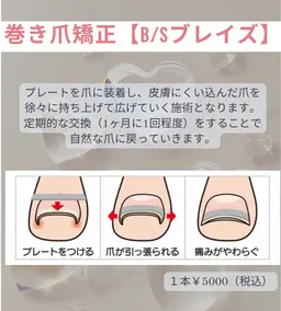 巻き爪矯正（1本）