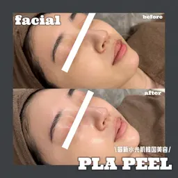【⭐️話題のプラスキンピーリング⭐️】➕美白➕高保湿💎✨️今より更にツヤ肌へ✨️韓国美容業界大注目🇰🇷