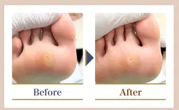 【魚の目ケア】足のゴアゴア痛い魚の目🌀綺麗な足裏へ✨