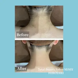 後ろ姿に自信◎うなじ脱毛【女性】60分