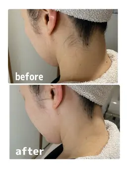 【襟足美人】うなじのシェービング＆脱毛🌹