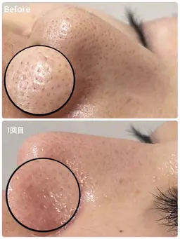 カウンセリング➡️クレンジング・洗顔➡️全顔の毛穴洗浄ハイドラ➡️仕上げの保湿になります✨️🪄︎︎