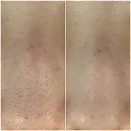 《毛穴の黒ずみ&ニキビケア》毛穴洗浄×ハーブピーリング 80分 デコルテ＆ショルダー＆ヘッドマッサージ付