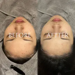 【ミニモ限定🌿スペシャルケア⭐️】ハーブピーリング＋LDMリフト🫧