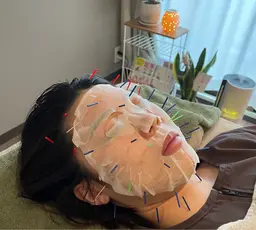 高級パック美容鍼