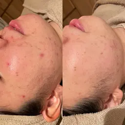 【💛期間限定💛】ニキビ、肌荒れでお悩みの方におすすめ✨ハーブピーリング＋超高保湿カスマラパック🌿