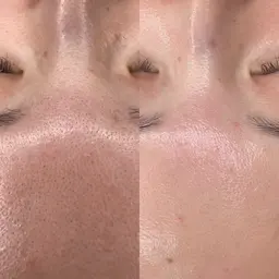 🇰🇷肌管理🫧アクアピール！毛穴洗浄で毛穴レス肌へ⭐︎クレンジング▶︎洗顔▶︎毛穴洗浄▶︎パック▶︎お仕上げ