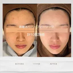 【肌悩みを改善したい方︎🙌🏻】人気No.1🌿ハーブピーリング🌿 しみ、シワ、ニキビ、ニキビ跡でお悩みの方！