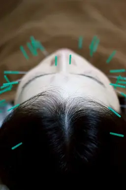 【#アオハル】 学割U24【4000円～】美容鍼20分￥10000円～→￥3000円～