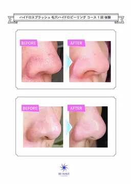 メイクノリ爆上がり✨黒ずみ・角栓スッキリ🫧水光ハイドロピール➕美容液導入