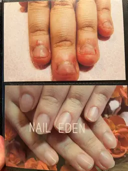 エデン式深爪ケアの初回スカルプチュアの装着。初回16000円→12000円