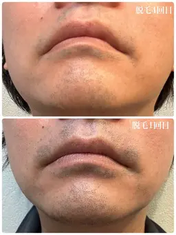 【minimoメンズ限定】メンズカット＆ヒゲ脱毛