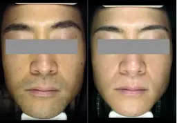 メンズ ヒゲ脱毛【強力痛少光脱毛】 ヒゲを無くして印象アップ→清潔・明るい・若く見える