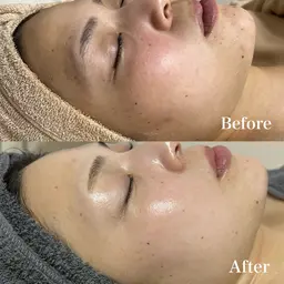 🦢【極・韓国美肌​〜​赤み・くすみ・キメ・美白​〜​】REVIハーブピーリング《陶肌トリートメント》➕シルク➕NMN➕IPSP