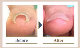 [新規限定]【巻き爪補正1ヵ所】 +【足の爪切りセット】　¥7,150→¥5,500